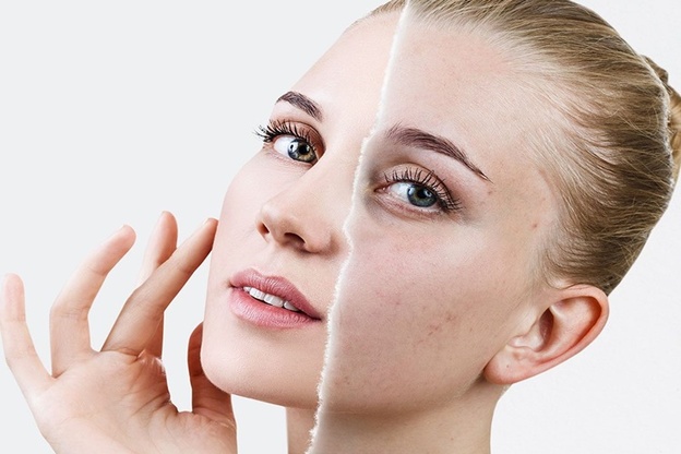 Cilt Lekeleri Hangi Vitamin Eksikliğinden Olur?