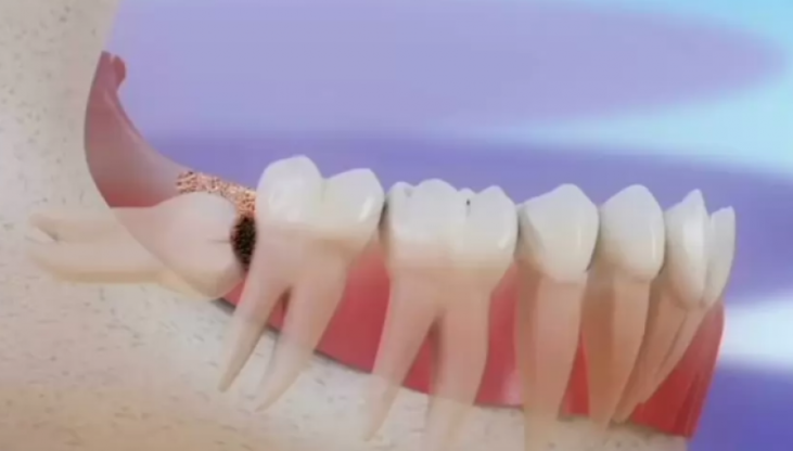 20'lik Diş Ağrısı Nasıl Geçer?